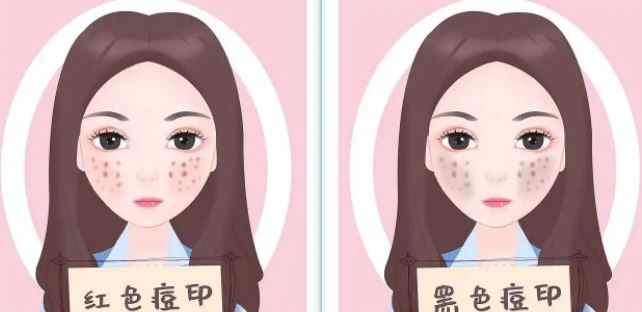 臉上紅色痘印幾個月都不消怎么辦？紅色痘印應(yīng)該怎么消除？