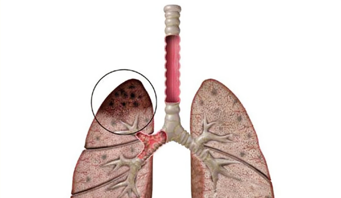 肺結核篩查做什么檢查？