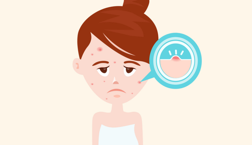 青春痘有救了嗎？聽(tīng)說(shuō)青春痘也有疫苗了？