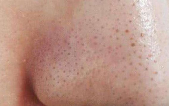 清潔面膜哪個牌子可以快速祛黑頭？趙薇、薇婭 推薦的紐西之謎泥膜真的好用嗎？